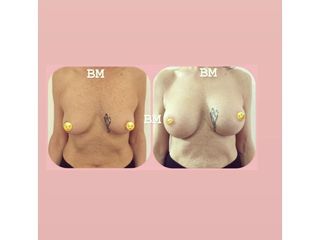 Mastoplastica additiva - Dr Benoit Menye