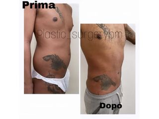 Liposuzione - Dr Benoit Menye