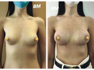 Mastoplastica additiva - Dr Benoit Menye