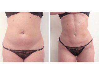 Liposuzione - Dr Benoit Menye
