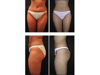 Liposuzione - Dr Benoit Menye