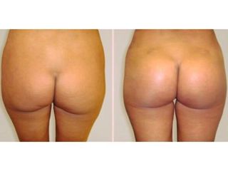 Gluteoplastica - Dr Benoit Menye