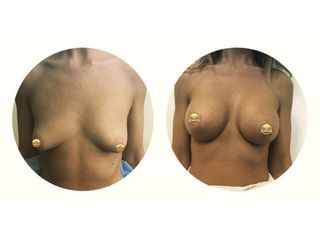 Mastoplastica additiva - Dr Benoit Menye