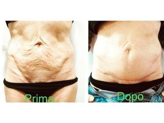Addominoplastica - Dr Benoit Menye