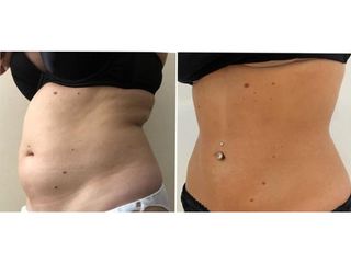 Liposuzione - Dr Benoit Menye