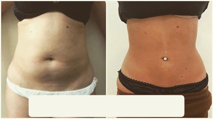 Liposuzione  - Dr Benoit Menye