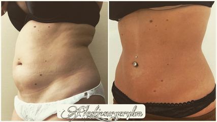 Liposuzione  - Dr Benoit Menye