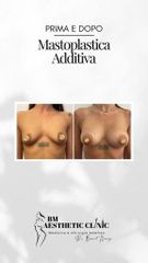 Mastoplastica additiva - Dr Benoit Menye