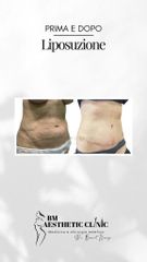 Liposuzione  - Dr Benoit Menye