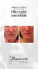 Filler - Dr Benoit Menye