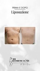 Liposuzione  - Dr Benoit Menye