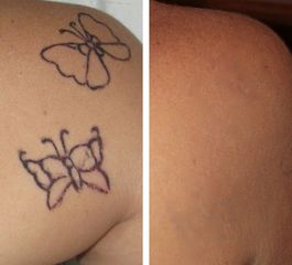 Rimozione tatuaggi prima e dopo