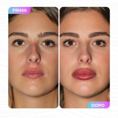 Filler labbra  - InFormaMedica - Centro di Chirurgia e Medicina Estetica