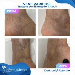 Vene varicose - InFormaMedica - Centro di Chirurgia e Medicina Estetica