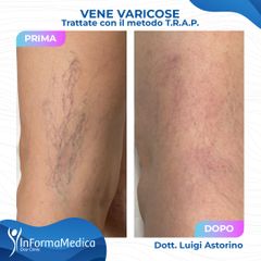 Vene varicose - InFormaMedica - Centro di Chirurgia e Medicina Estetica