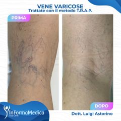 Vene varicose - InFormaMedica - Centro di Chirurgia e Medicina Estetica