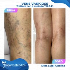 Vene varicose - InFormaMedica - Centro di Chirurgia e Medicina Estetica