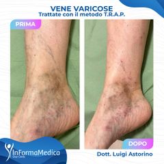 Vene varicose - InFormaMedica - Centro di Chirurgia e Medicina Estetica