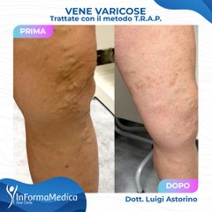 Vene varicose - InFormaMedica - Centro di Chirurgia e Medicina Estetica