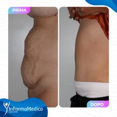 Addominoplastica - InFormaMedica - Centro di Chirurgia e Medicina Estetica