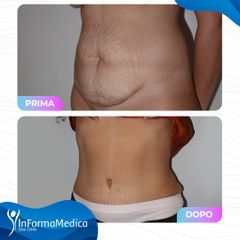 Addominoplastica - InFormaMedica - Centro di Chirurgia e Medicina Estetica