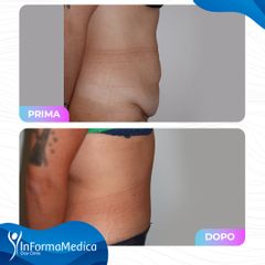 Addominoplastica - InFormaMedica - Centro di Chirurgia e Medicina Estetica