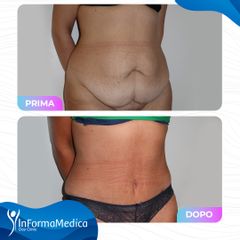 Addominoplastica - InFormaMedica - Centro di Chirurgia e Medicina Estetica