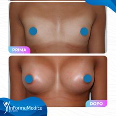 Mastoplastica additiva - InFormaMedica - Centro di Chirurgia e Medicina Estetica