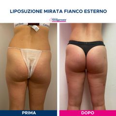 Liposuzione  - Cliniche Novagenesis - dott. Alberto Rossi Todde