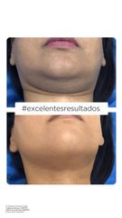 Antes y después de Liposucción de cuello 