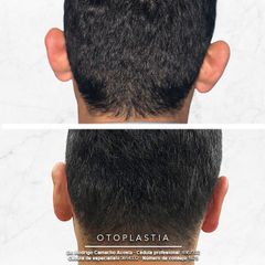 Antes y después de Otoplastia