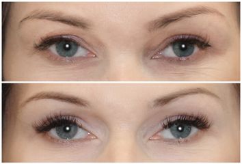 Blefaroplastyka - Dr Michał Charytonowicz