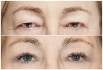 Blefaroplastyka - Dr Michał Charytonowicz