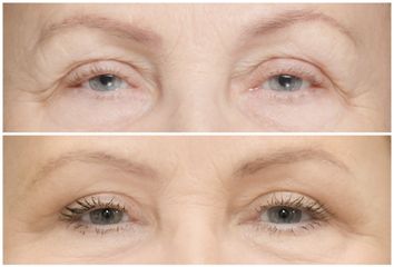 Blefaroplastyka - Dr Michał Charytonowicz