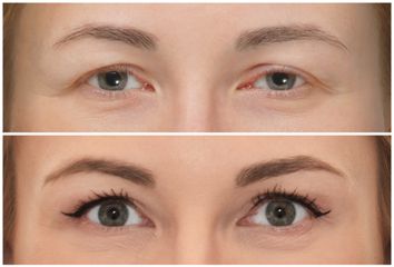 Blefaroplastyka - Dr Michał Charytonowicz