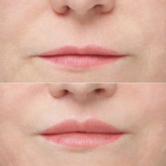 liplift - lek. med. Jakub Miszczyk