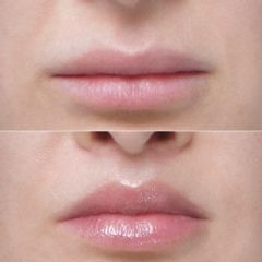 liplift - lek. med. Jakub Miszczyk