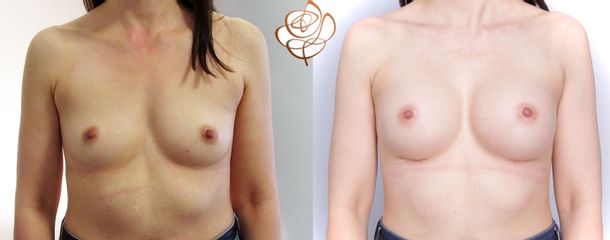 Powiększanie biustu - dr n.med. Daria Charytonowicz - Klinika Dr Szczyt