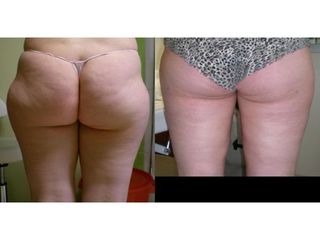 Liposukcja bryczesów - przed i po