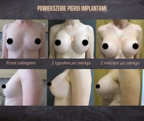 Powiększanie piersi - przed  po