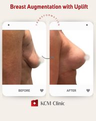 Powiększanie biustu - KCM Clinic Chirurgia Plastyczna i Bariatria