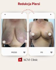 Zmniejszenie biustu - KCM Clinic Chirurgia Plastyczna i Bariatria