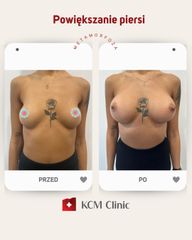 Powiększanie biustu - KCM Clinic Chirurgia Plastyczna i Bariatria