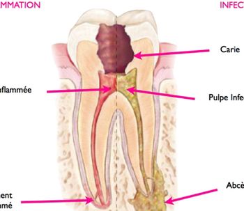 Qu’est-ce que l’endodontie ?