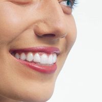L’orthodontie invisible et amovible