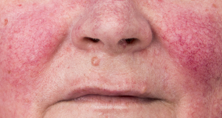 Causes et traitements de la couperose