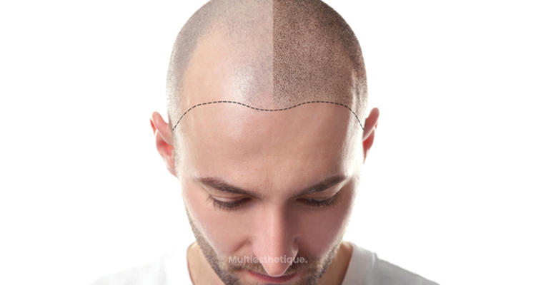 Tout savoir sur la transplantation capillaire par cellules souches