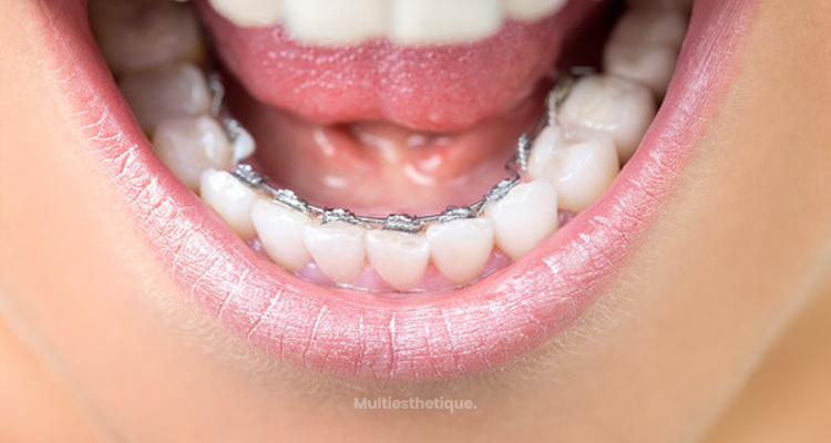L’orthodontie linguale, une solution en toute discrétion
