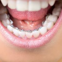 L’orthodontie linguale, une solution en toute discrétion