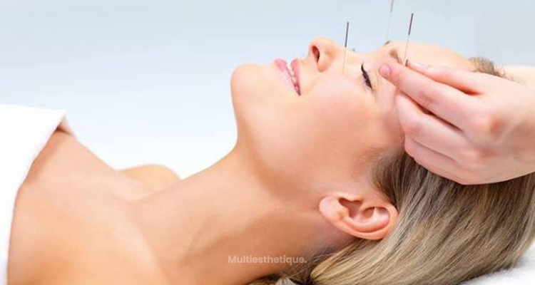 Lifting par acupuncture pour un rajeunissement naturel du visage